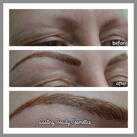 Permanent Eyebrows for Alopecia Patients